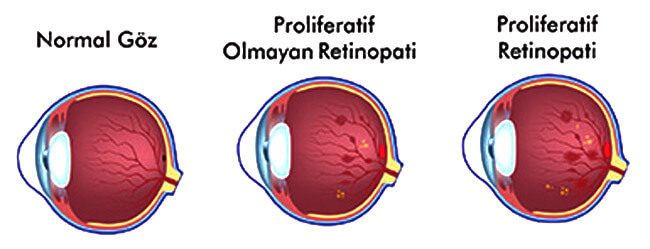 şeker hastalığı